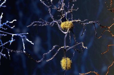 New Insights into Alzheimer’s: Brain Autopsies Point to Potential Culprit